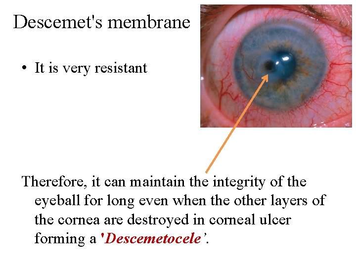Descemet's membrane • It is very resistant Therefore, it can maintain the integrity of