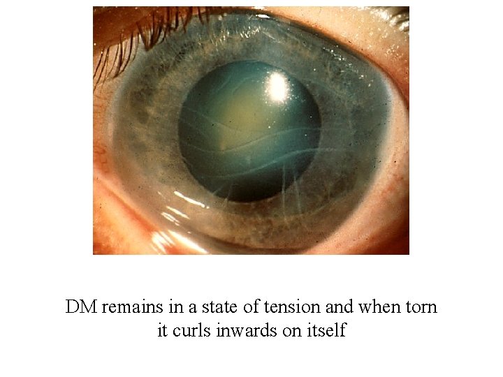 DM remains in a state of tension and when torn it curls inwards on