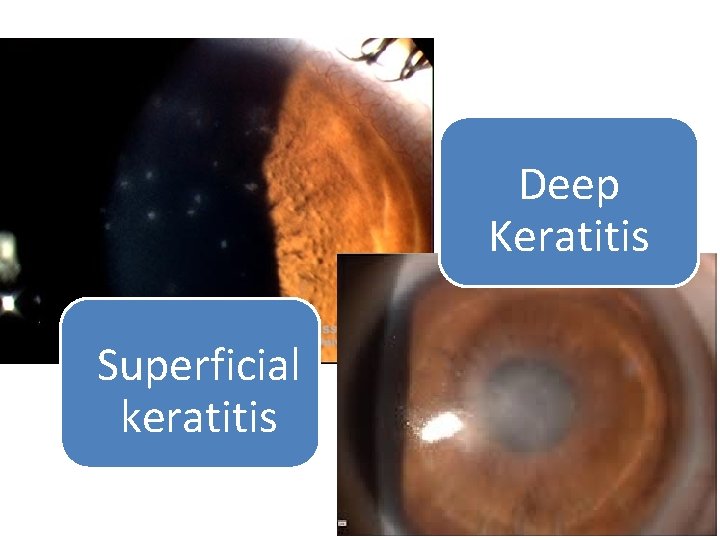 Deep Keratitis Superficial keratitis 