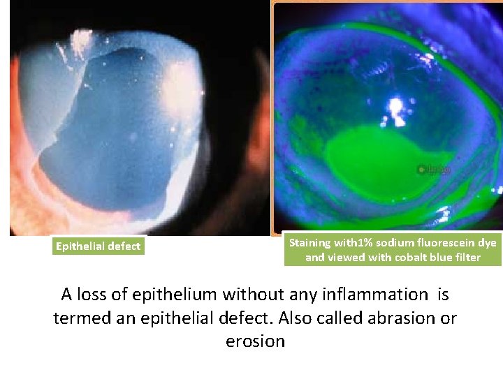 Epithelial defect Staining with 1% sodium fluorescein dye and viewed with cobalt blue filter