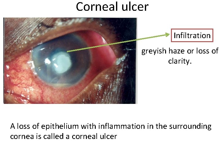 Corneal ulcer Infiltration greyish haze or loss of clarity. A loss of epithelium with