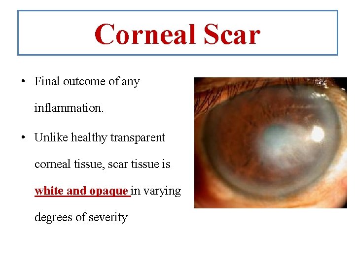 Corneal Scar • Final outcome of any inflammation. • Unlike healthy transparent corneal tissue,