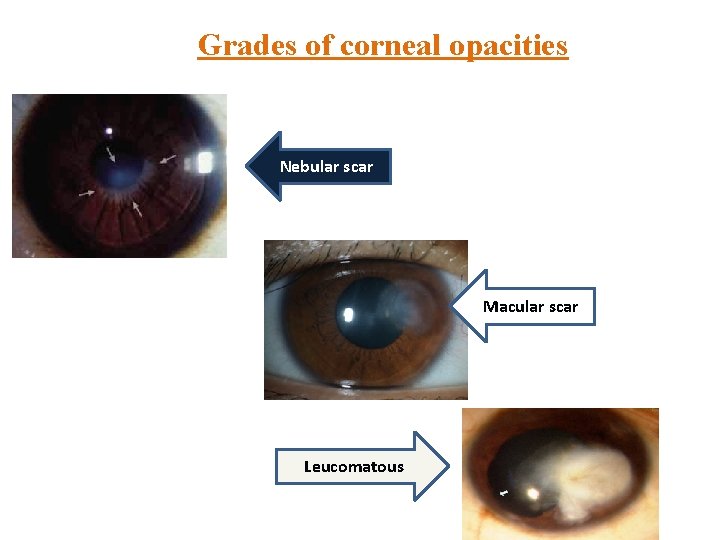 Grades of corneal opacities Nebular scar Macular scar Leucomatous 