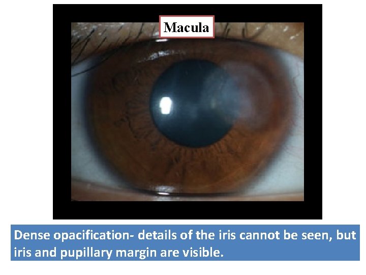 Macula Dense opacification- details of the iris cannot be seen, but iris and pupillary