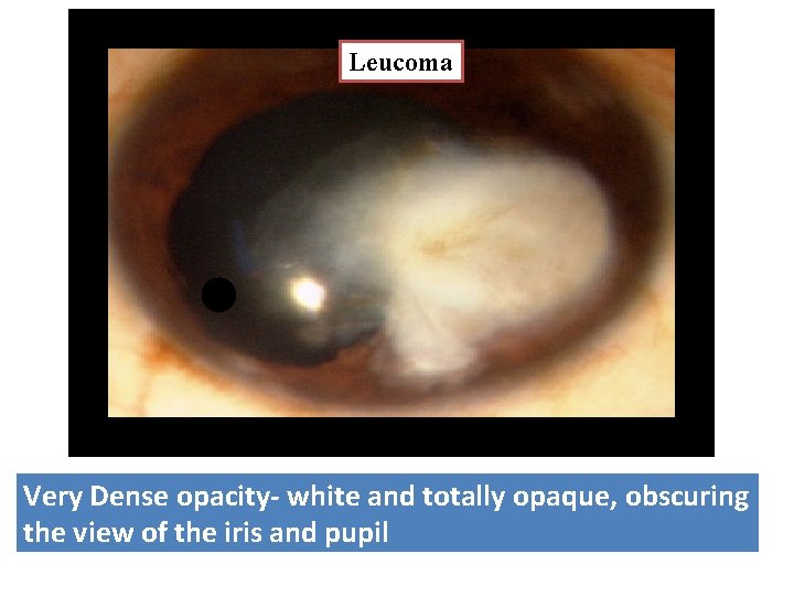 Leucoma Very Dense opacity- white and totally opaque, obscuring the view of the iris