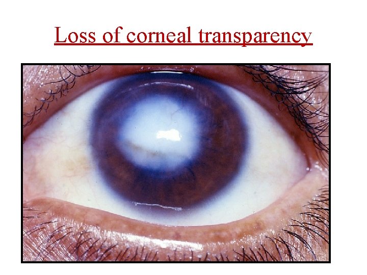 Loss of corneal transparency 
