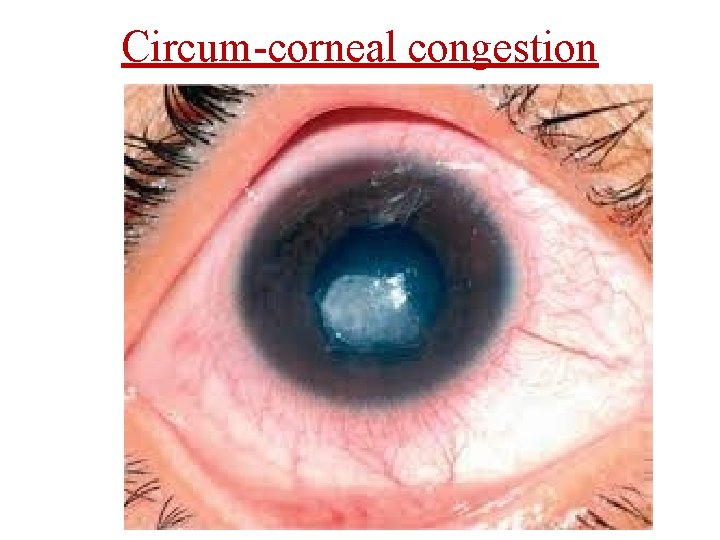 Circum-corneal congestion 