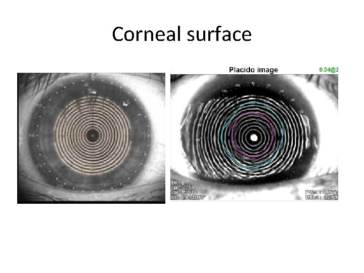 Corneal surface 