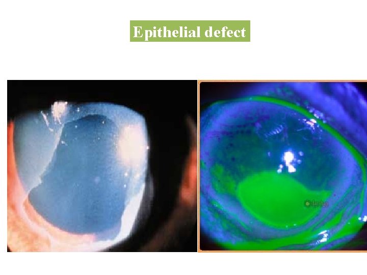 Epithelial defect 