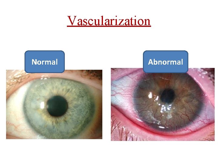 Vascularization Normal Abnormal 