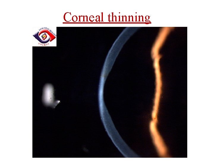 Corneal thinning 