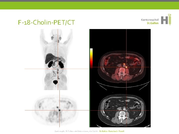 F-18 -Cholin-PET/CT 