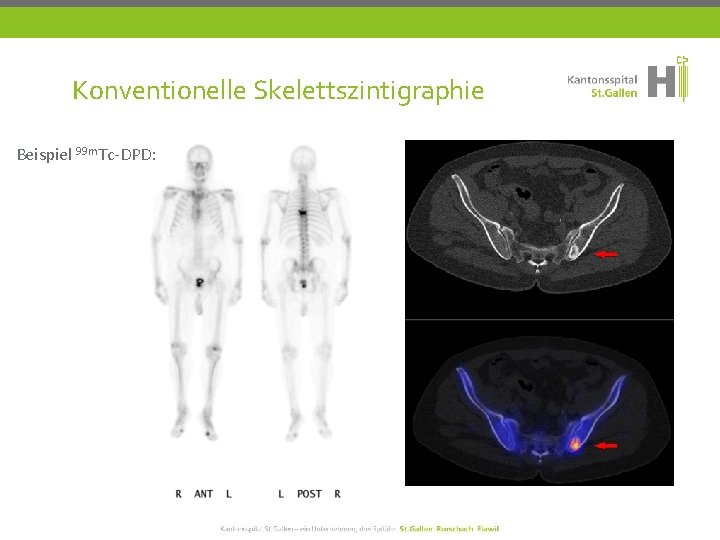 Konventionelle Skelettszintigraphie Beispiel 99 m. Tc-DPD: 