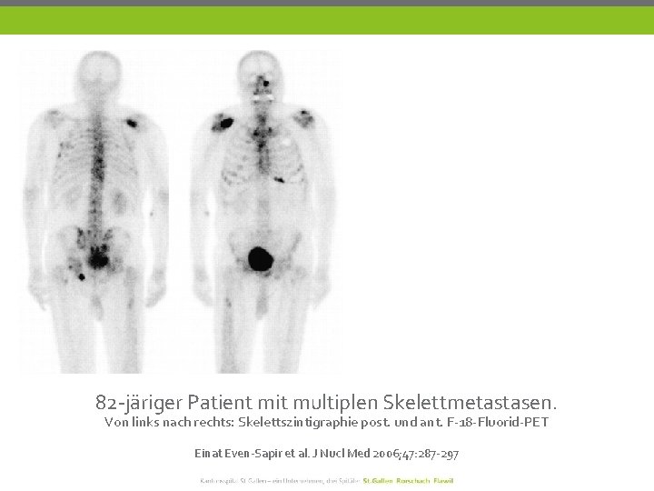 82 -järiger Patient mit multiplen Skelettmetastasen. Von links nach rechts: Skelettszintigraphie post. und ant.