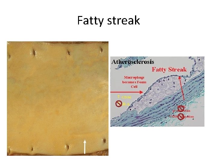 Fatty streak 