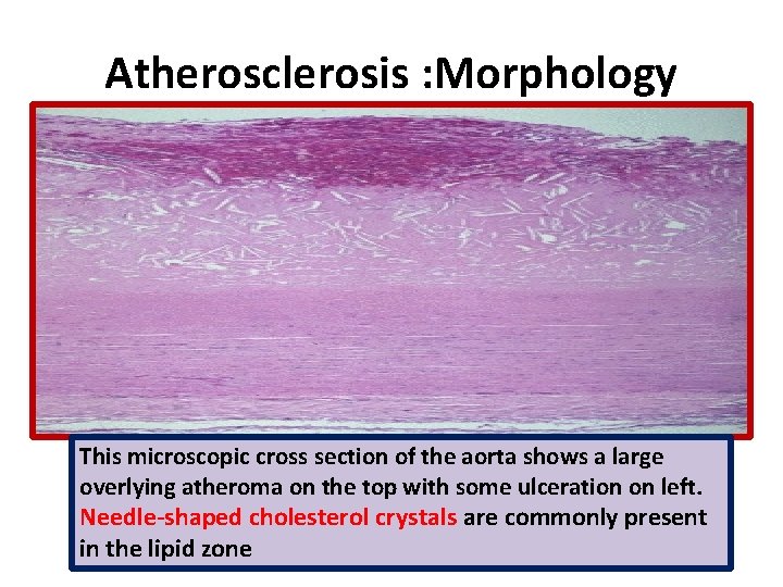 Atherosclerosis : Morphology This microscopic cross section of the aorta shows a large overlying