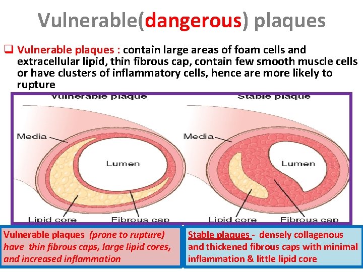 Vulnerable(dangerous) plaques q Vulnerable plaques : contain large areas of foam cells and extracellular