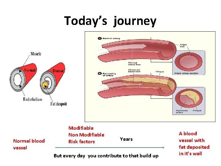 Today’s journey Normal blood vessel Modifiable Non Modifiable Risk factors Years But every day