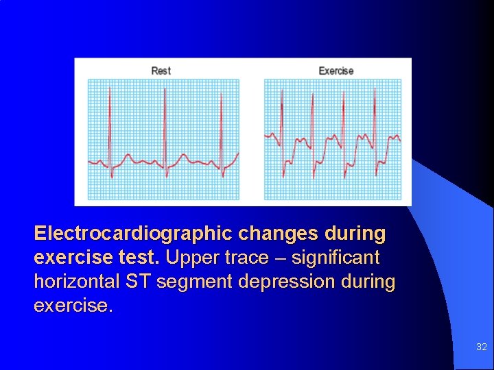 Electrocardiographic changes during exercise test. Upper trace – significant horizontal ST segment depression during
