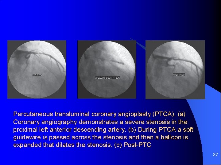 Percutaneous transluminal coronary angioplasty (PTCA). (a) Coronary angiography demonstrates a severe stenosis in the
