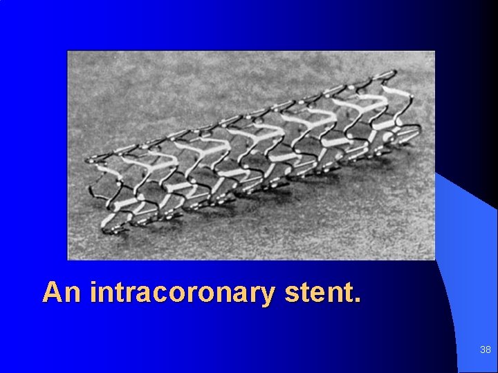An intracoronary stent. 38 