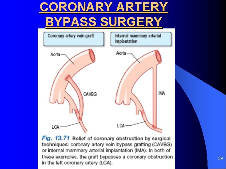 CORONARY ARTERY BYPASS SURGERY 39 