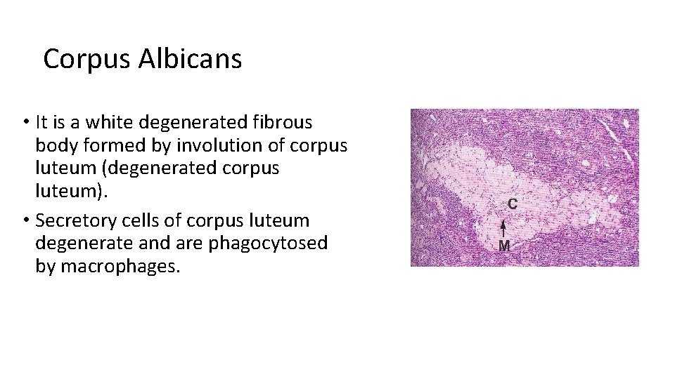 Corpus Albicans • It is a white degenerated fibrous body formed by involution of