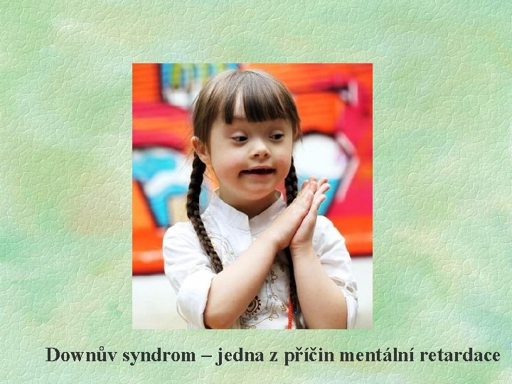 Downův syndrom – jedna z příčin mentální retardace 