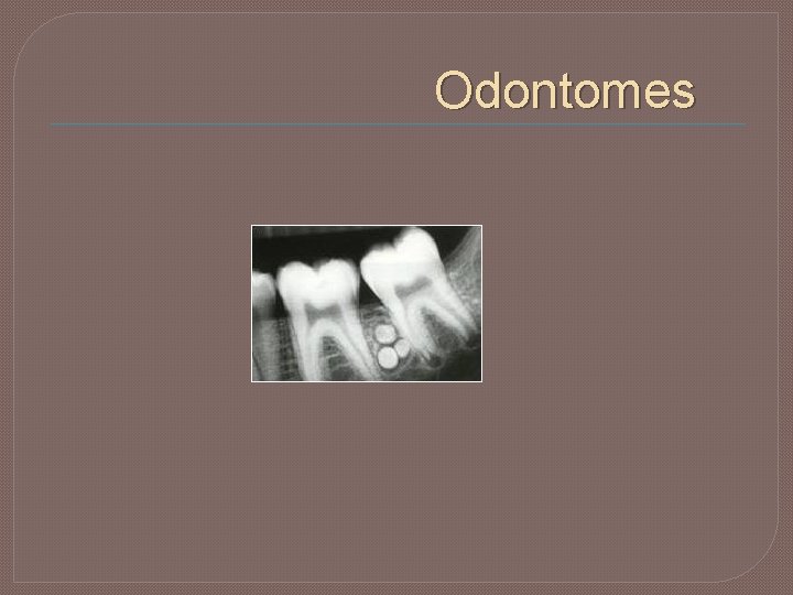 Odontomes 