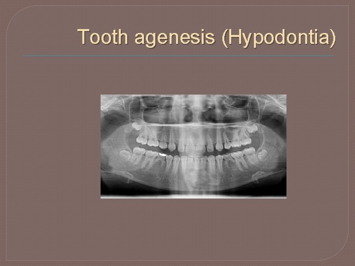 Tooth agenesis (Hypodontia) 
