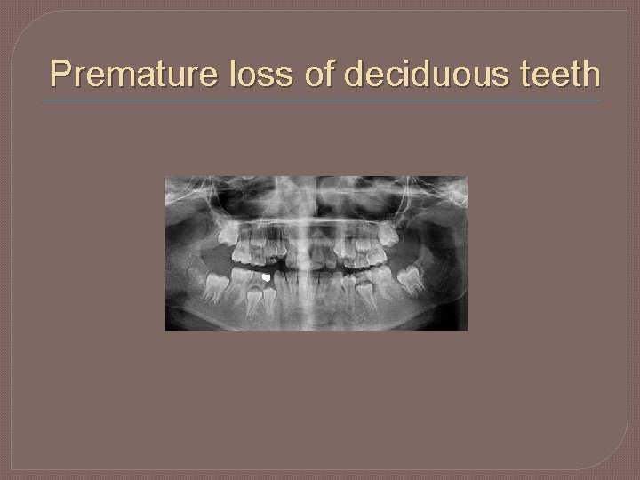 Premature loss of deciduous teeth 
