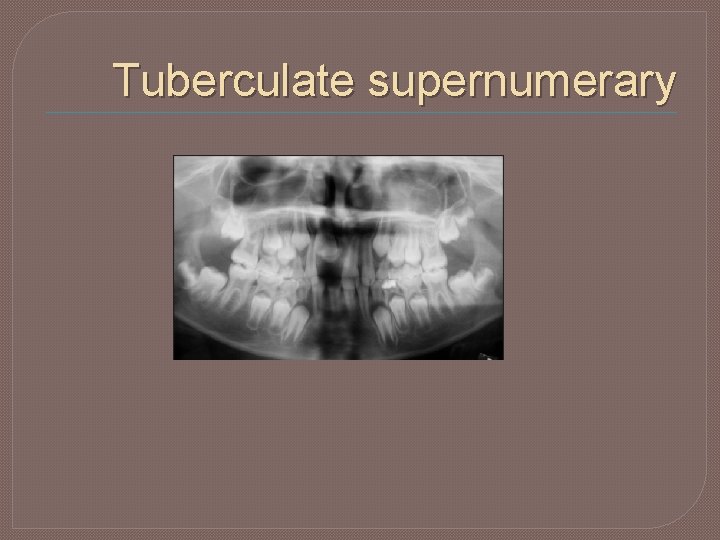 Tuberculate supernumerary 