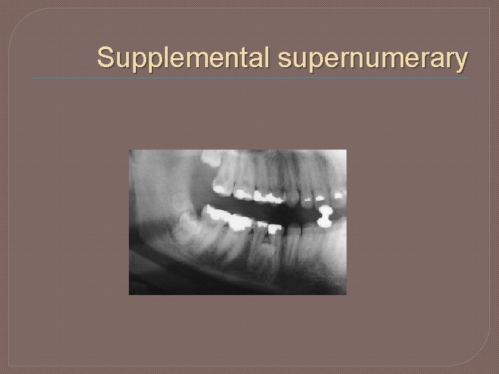 Supplemental supernumerary 