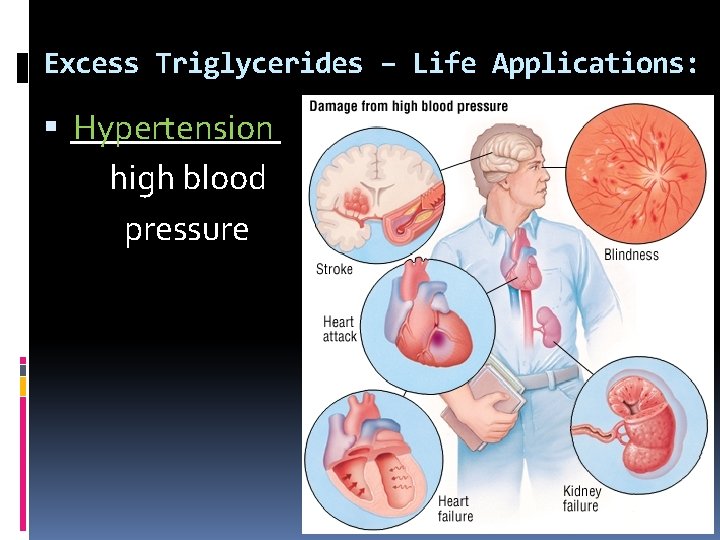 Excess Triglycerides – Life Applications: Hypertension ______ high blood pressure 