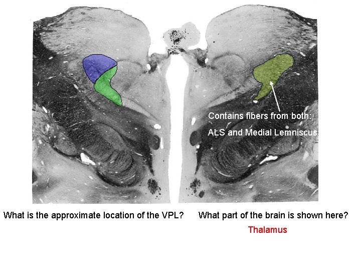 Contains fibers from both: ALS and Medial Lemniscus What is the approximate location of