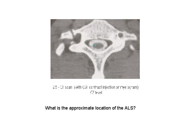 What is the approximate location of the ALS? 