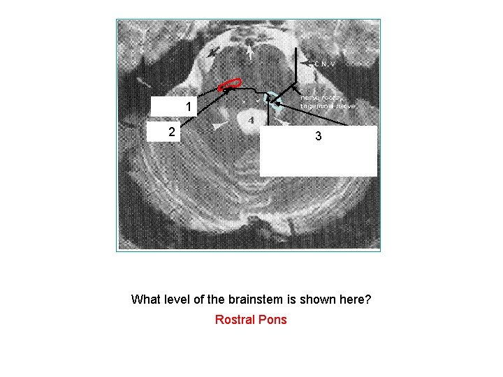 C. N. V nerve roots, trigeminal nerve Medial 1 lemniscus VTTT 2 Motor (medial)