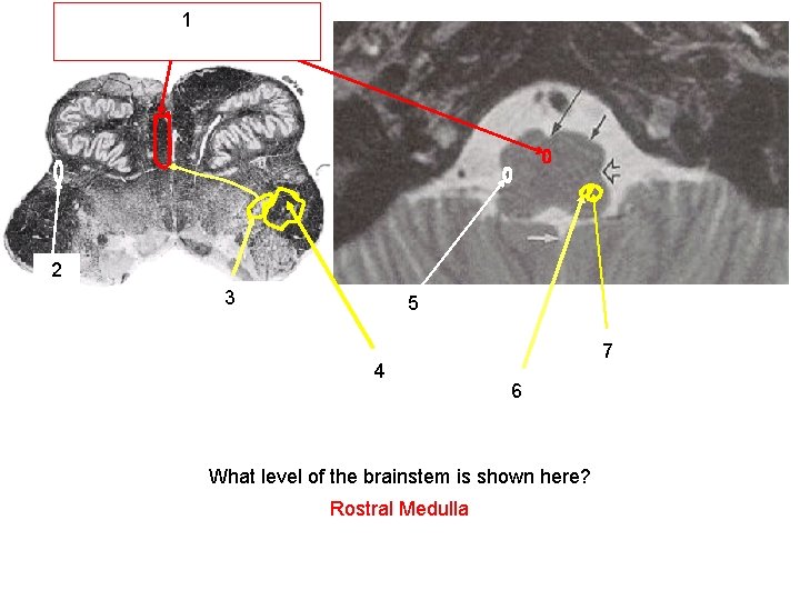 1 POSITION OF MEDIAL LEMNISCUS (outlined in red) ALS 2 Spinal trigeminal 3 nucleus