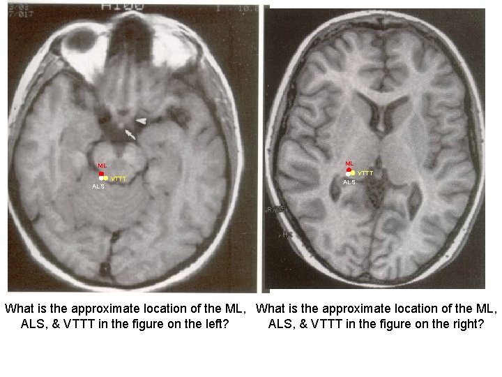 Medial Lemniscus ML ML VTTT ALS PAG VTTT What is the approximate location of