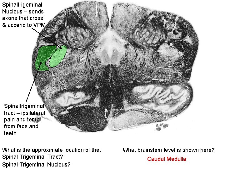 Spinaltrigeminal Nucleus – sends axons that cross & accend to VPM Spinaltrigeminal tract –