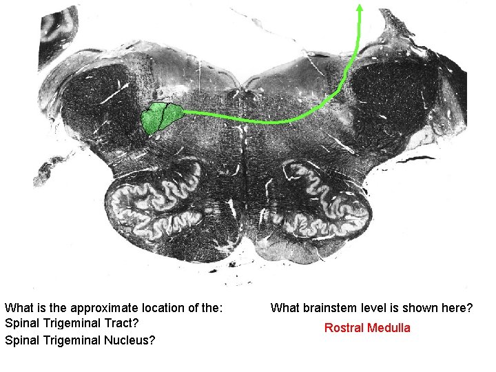 What is the approximate location of the: Spinal Trigeminal Tract? Spinal Trigeminal Nucleus? What