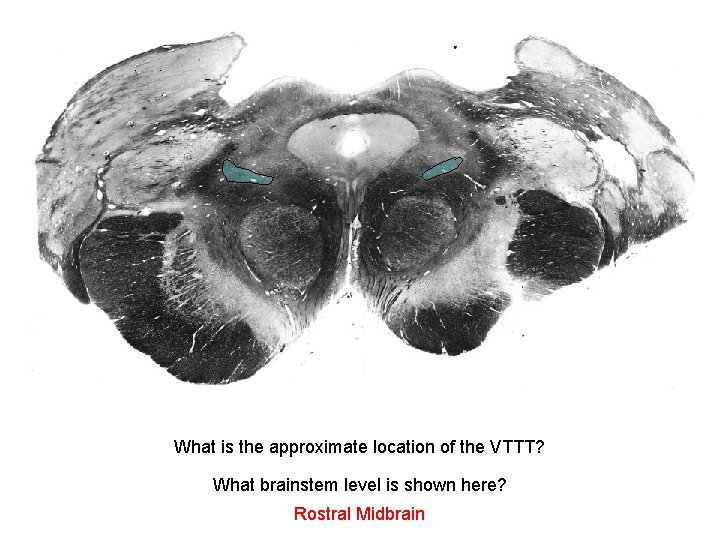 What is the approximate location of the VTTT? What brainstem level is shown here?