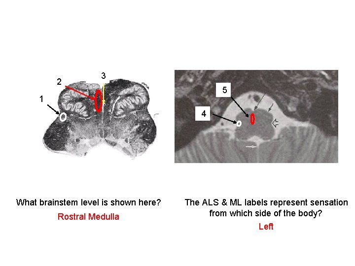 2 ML raphe 3 nuclei 5 ML ALS 1 ALS 4 What brainstem level