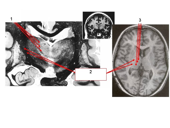 Internal medullary lamina + Intralaminar nuclei General location: Internal medullary lamina + intralaminar nuclei