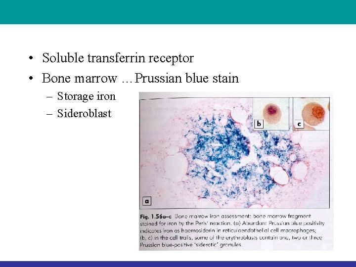  • Soluble transferrin receptor • Bone marrow …Prussian blue stain – Storage iron