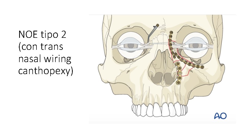 NOE tipo 2 (con trans nasal wiring canthopexy) 