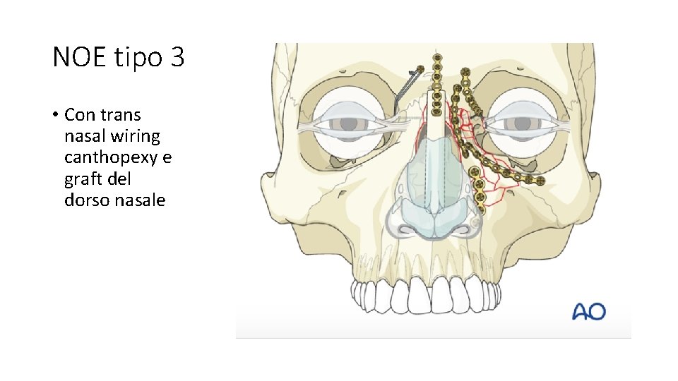 NOE tipo 3 • Con trans nasal wiring canthopexy e graft del dorso nasale