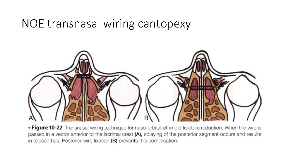 NOE transnasal wiring cantopexy 