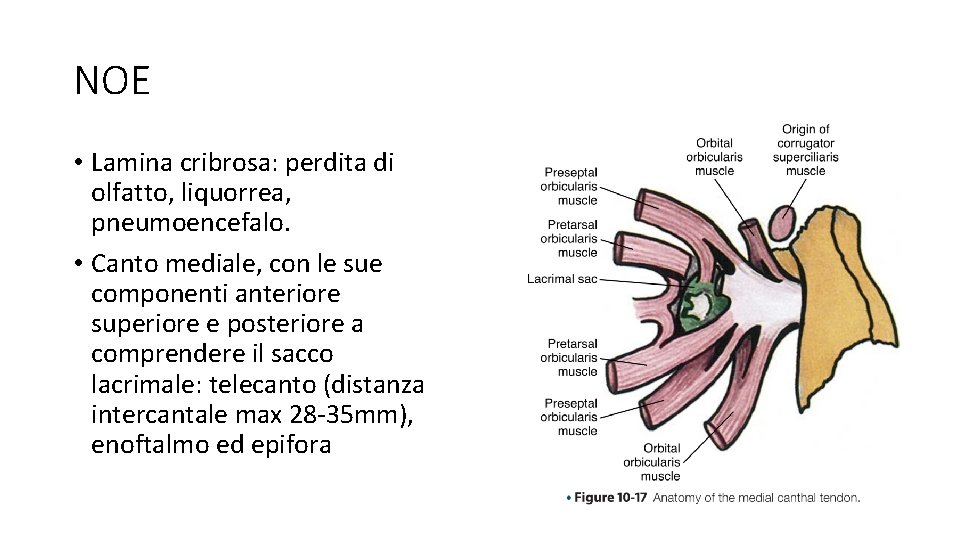 NOE • Lamina cribrosa: perdita di olfatto, liquorrea, pneumoencefalo. • Canto mediale, con le