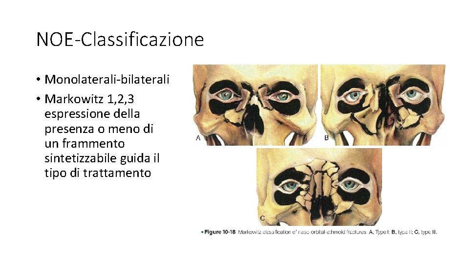 NOE-Classificazione • Monolaterali-bilaterali • Markowitz 1, 2, 3 espressione della presenza o meno di